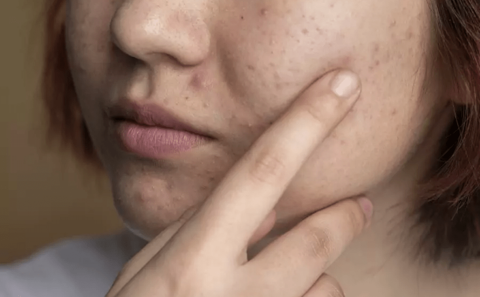 Acne grade 1: Know the characteristics and how to identify it - Creamy Skincare