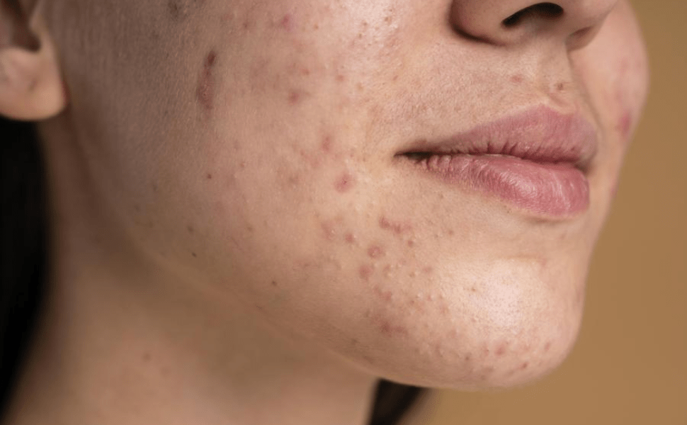 Acne grade 2: everything you need to know - Creamy Skincare