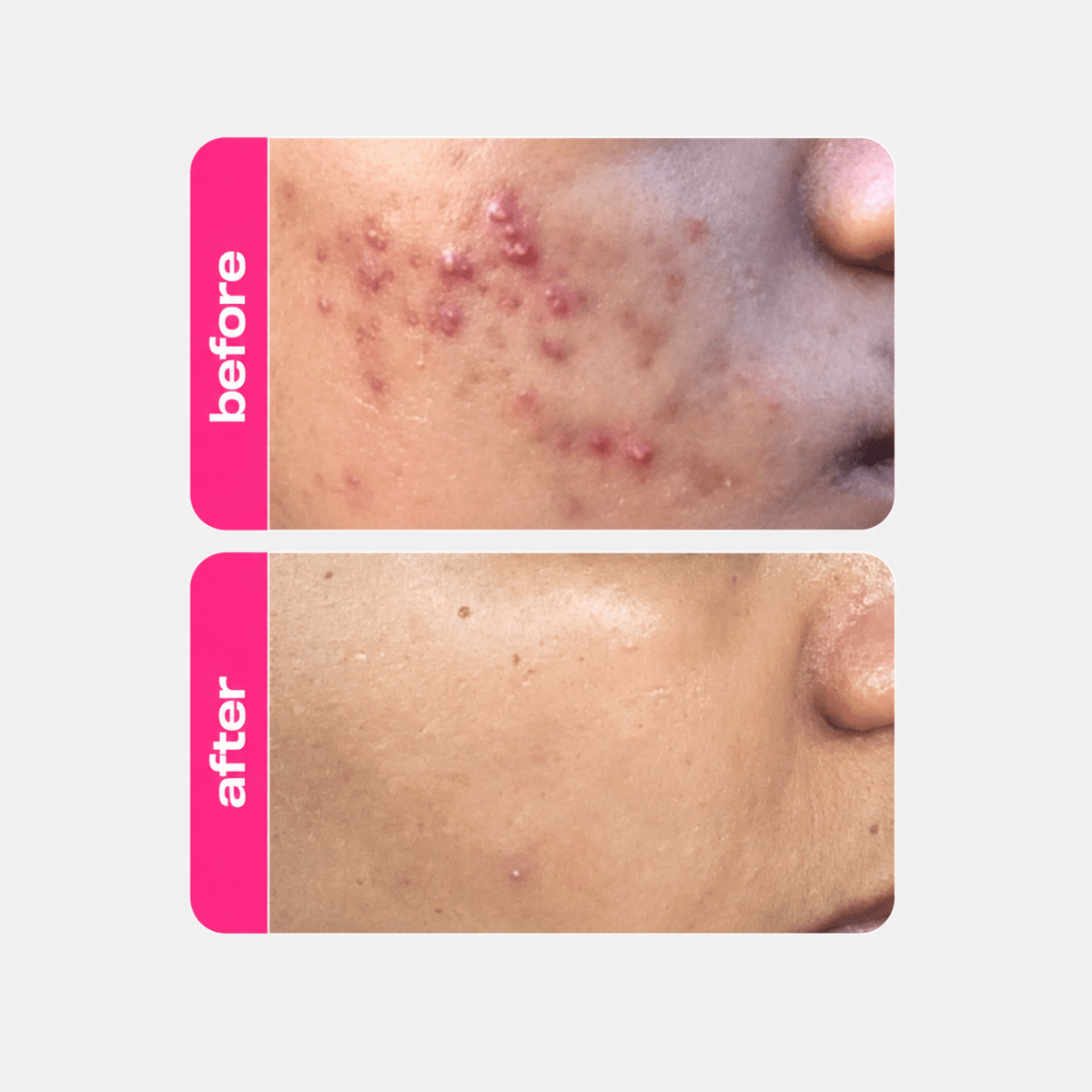 CREAMY Blemish Control 7% Mandelic Gel - Creamy Skincare