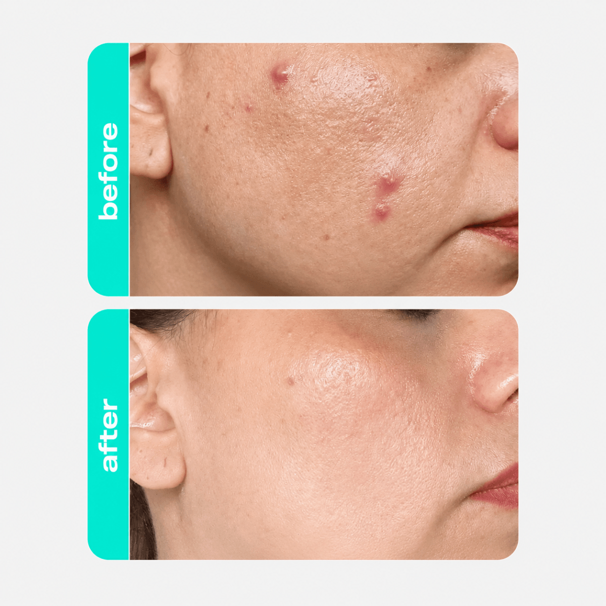 CREAMY Salicylic Acid Toner - Creamy Skincare